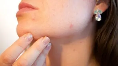 Ilustrasi wajah remaja dengan jerawat yang sedang diobati secara alami menggunakan masker herbal