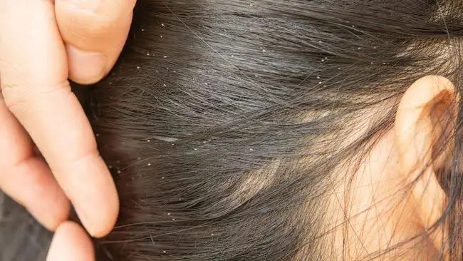 Cara Menghilangkan Kutu Rambut Secara Alami