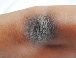 Cara Menghilangkan Siku Hitam Secara Alami