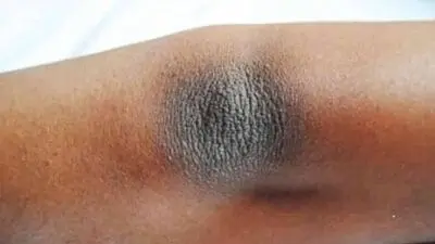Cara Menghilangkan Siku Hitam Secara Alami