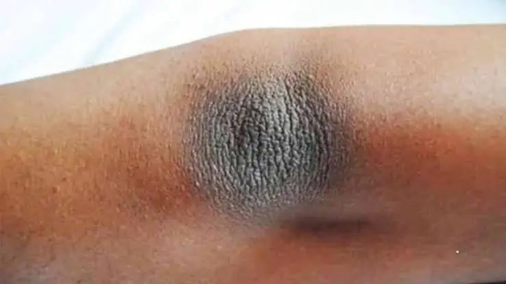 Cara Menghilangkan Siku Hitam Secara Alami