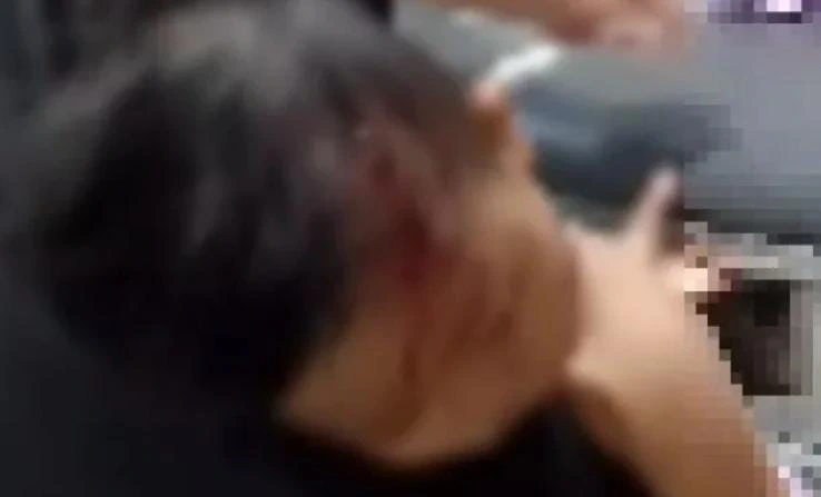 Balita diserang monyet di Sampang mengalami luka pada pipi kiri
